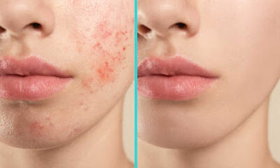 Cecylia Licensed Esthetician – leczenie trądziku