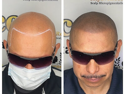 Rejuvenecer Scalp Micro Pigmentation