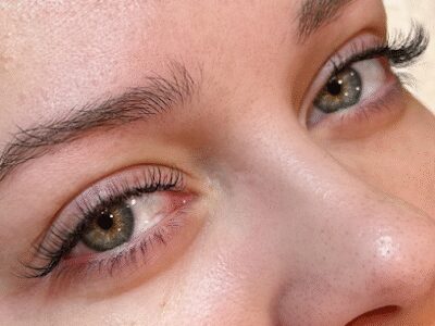 Freckled Esthetics